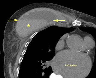 hematoma in breast best japan porn web
